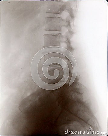 Spine and pelvis xray (x-ray) Stock Photo